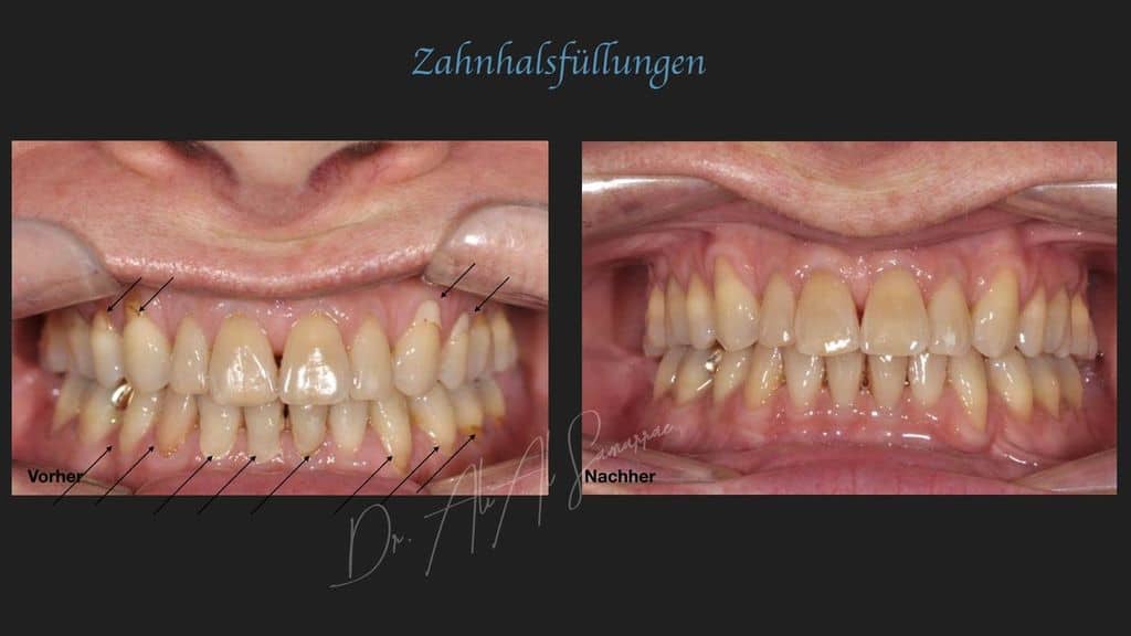 Zahnhalsfüllungen - Beispiel 7