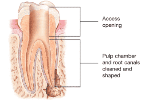 Zahnwurzel und Wurzelbehandlung