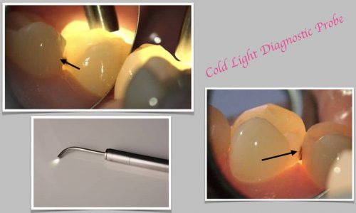 Zahndiagnostik mit Hilfe einer Kaltlichtsonde
