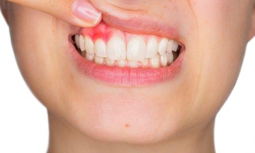 Entzündetes Zahnfleisch im Mund einer Patientin
