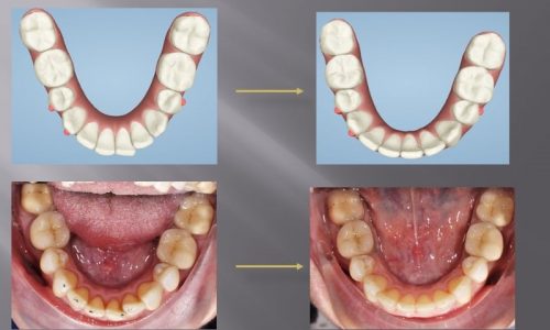 Vergleich vorher und nachher bei einer Zahnkorrektur mit Invisalign.