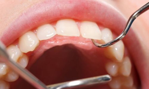 Eine Dentalhygieniker entfernt bei der Mundhygiene professionell Plaque und Zahnstein auf Ihren Zähnen