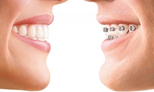 Vergleich der transparenten Invisalign-Schiene mit einer normalen Zahnspange